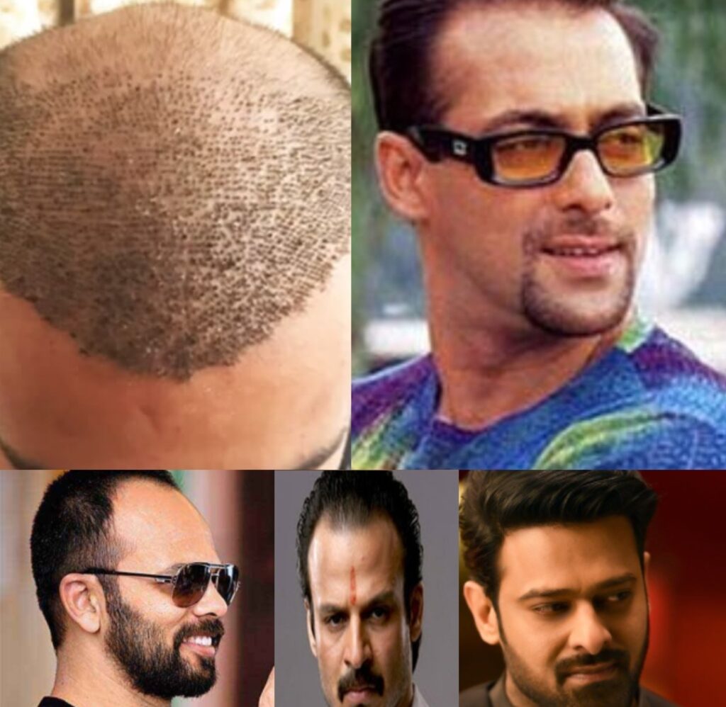 Famous Indian celebrities who have undergone Hair transplant surgery